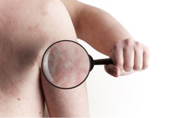 causas de los brotes de psoriasis