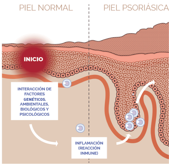 brote de psoriasis