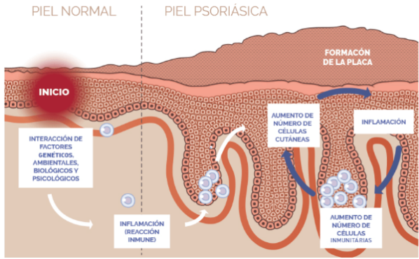 brote de psoriasis