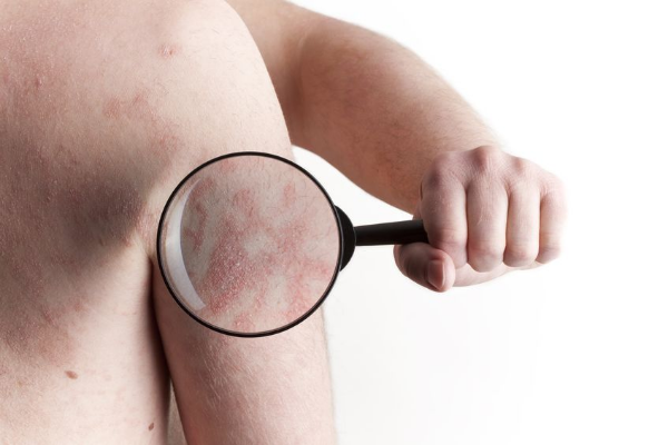 tipos de psoriasis con imgenes tipos de psoriasis con imagenes