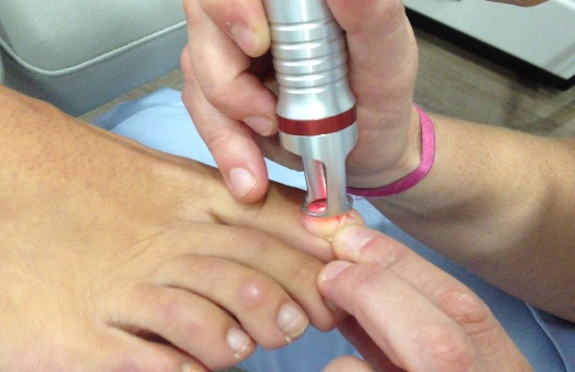 Tratamiento láser para las uñas del pie infectadas por hongos