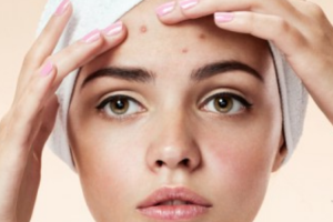 como-acabar-con-el-acne-en-adultos como-acabar-con-el-acne-en-adultos