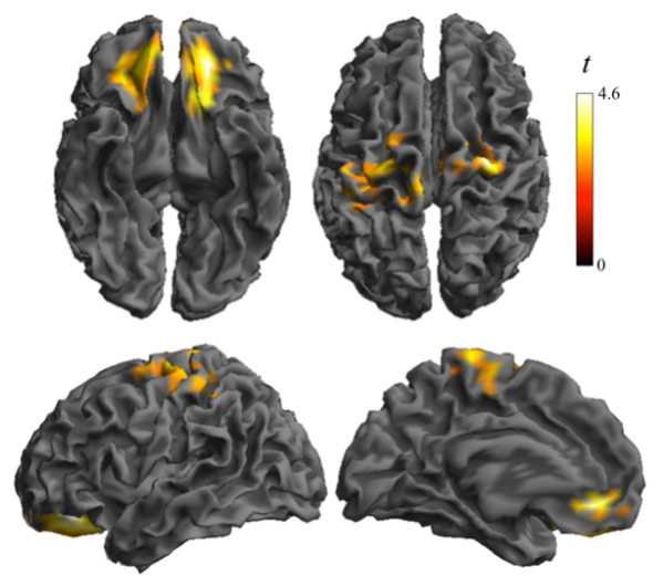 detectan-alteraciones-en-el-cerebro-de-los-ninos-y-ninas-obesos